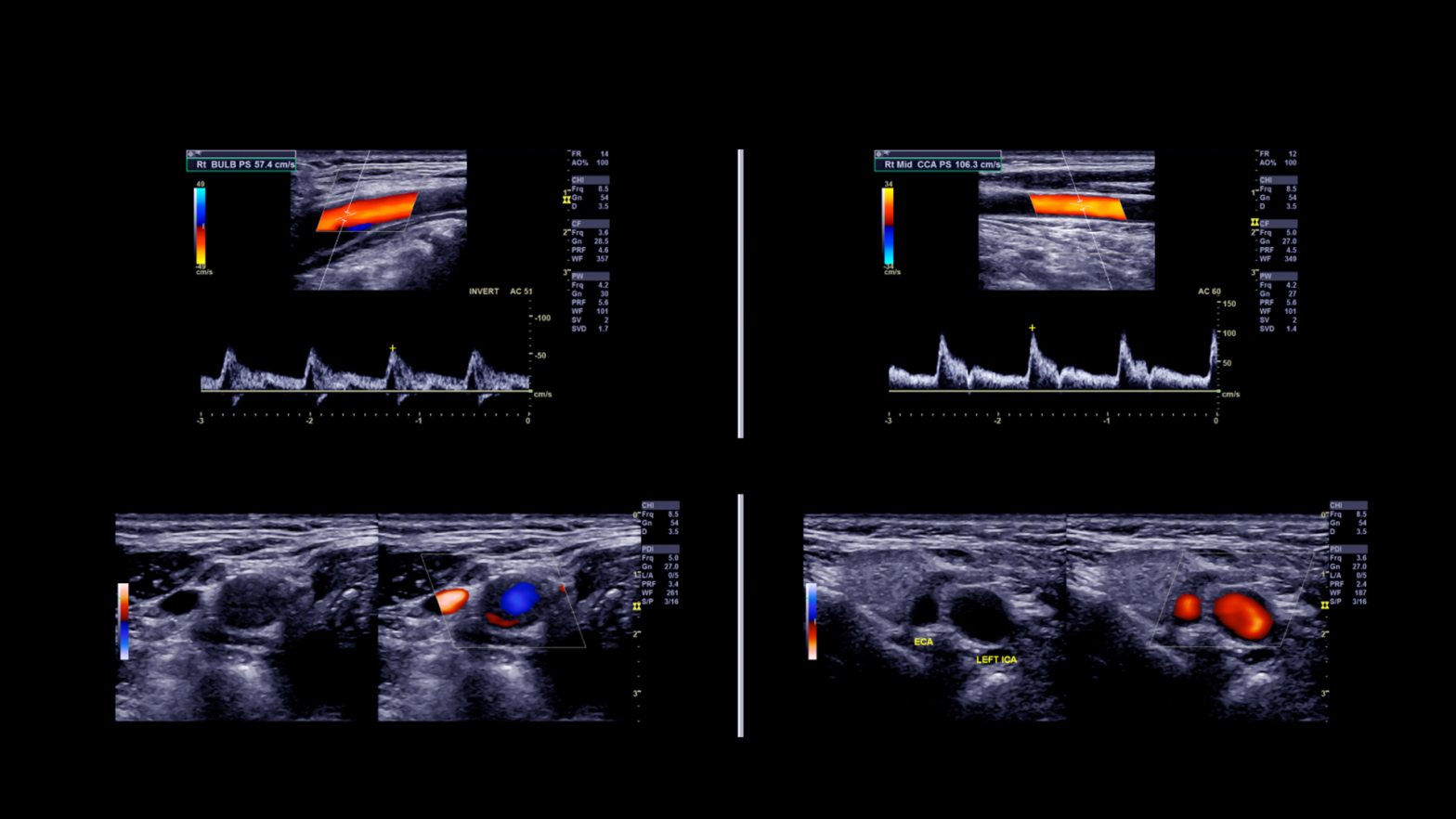Tecnología médica avanzada: Doppler Duplex Color